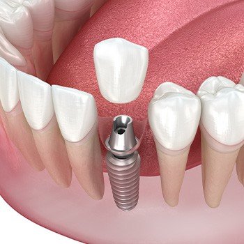 Illustration of single dental implant and crown in lower arch