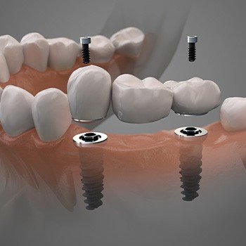 Illustration of dental bridge being placed on dental implants