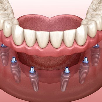 Illustration of dentures being anchored to dental implants in the lower jaw