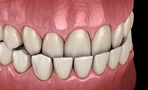 Illustration of an underbite