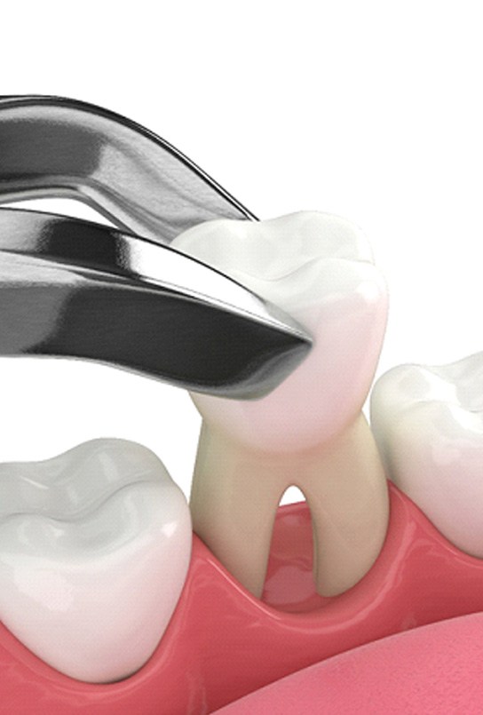 Illustration of a tooth extraction in Kent, WA